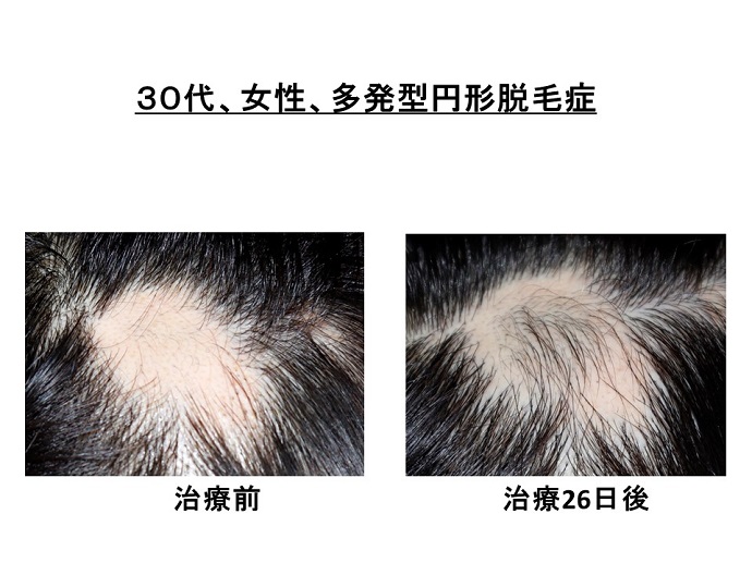 円形脱毛症　病院